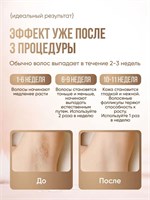 Лазерный фотоэпилятор предназначен для удаления волос 1000025348